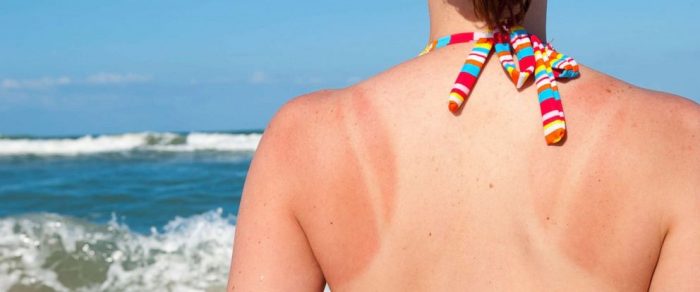 girl in bathers showing tan lines on her back by the beach