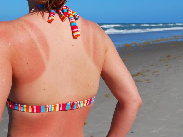 First Aid For Sunburn